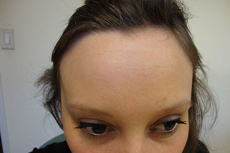 forehead