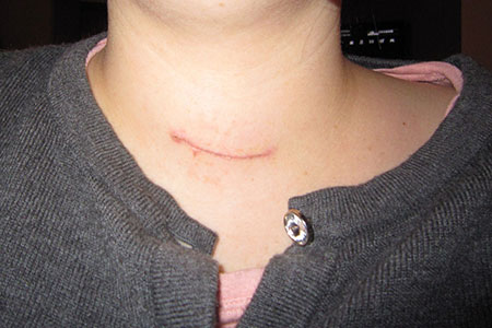 scar