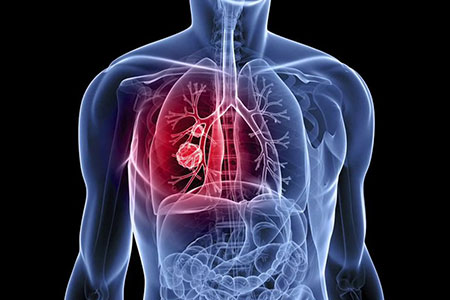 tumor (tumour)